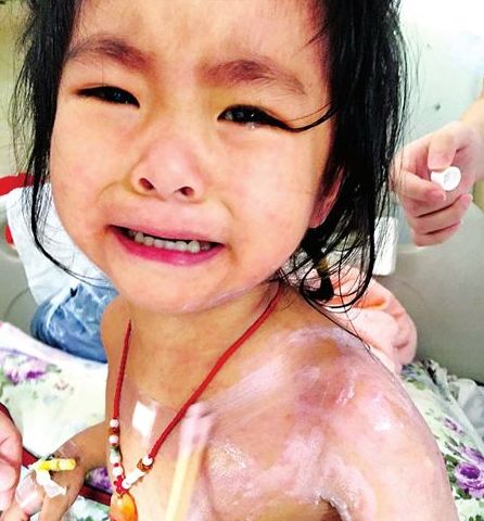 3歲的蘭蘭，全身紅疹，因疼癢難忍而大哭